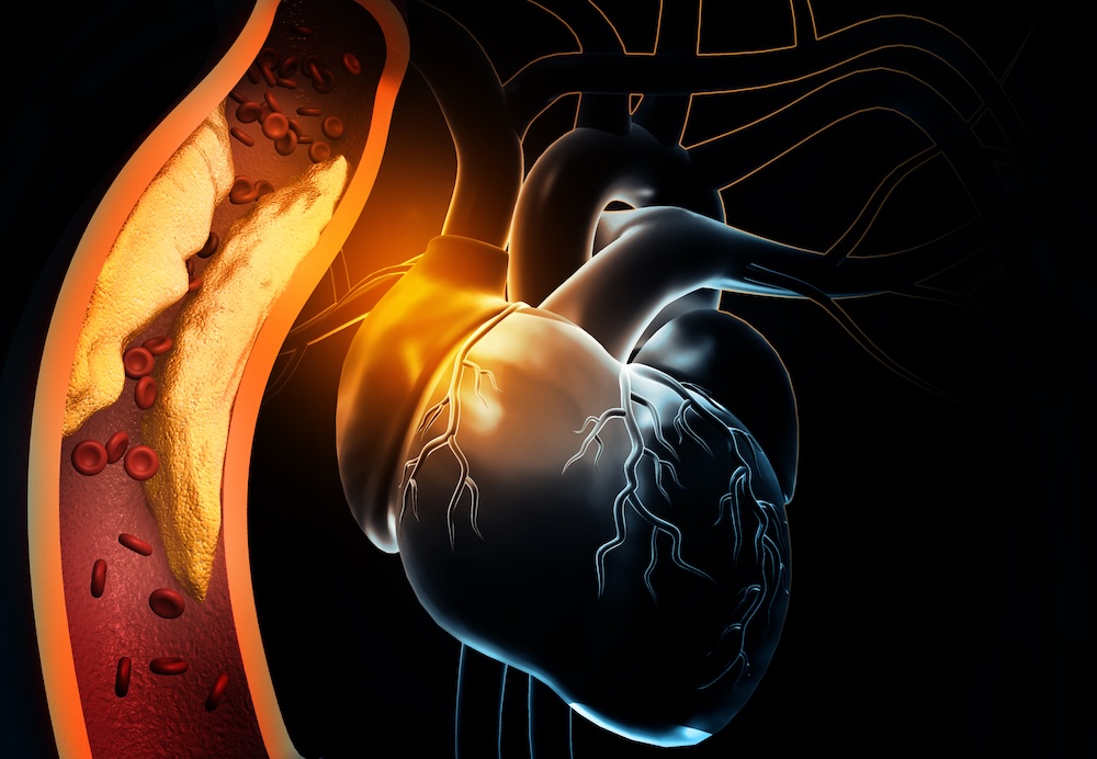Structural Heart Intervention